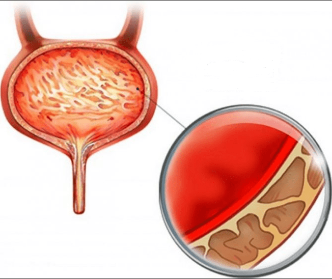 Inflamación de la cistitis