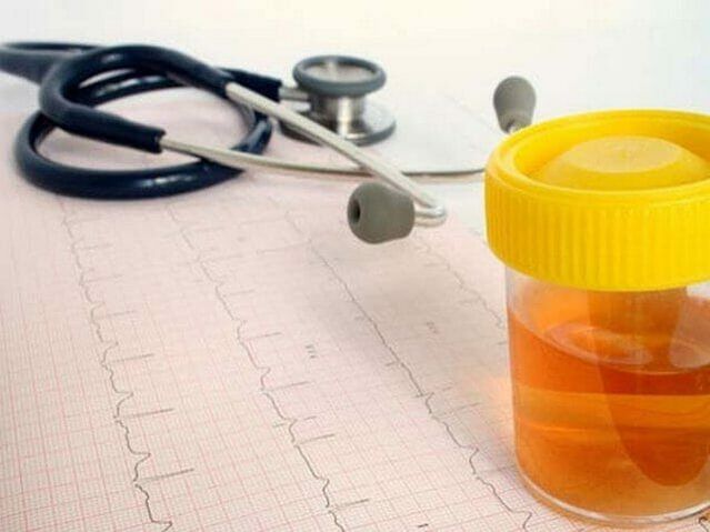 Análisis de orina para diagnosticar cistitis.